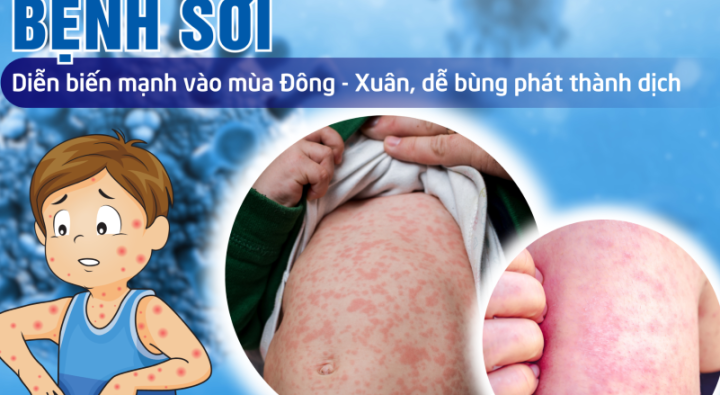 Dịch sởi ở trường học