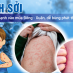 Dịch sởi ở trường học