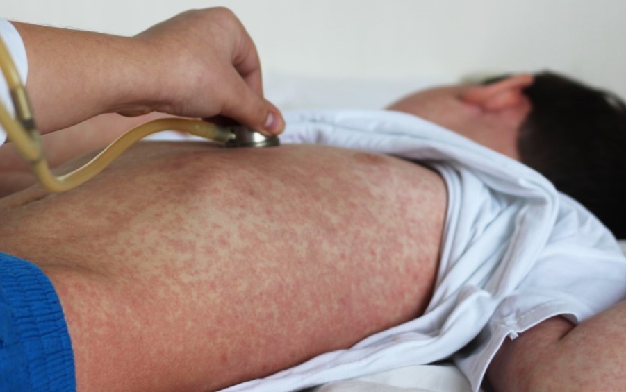 Dấu hiệu bệnh sởi đặc trưng nhất là phát ban